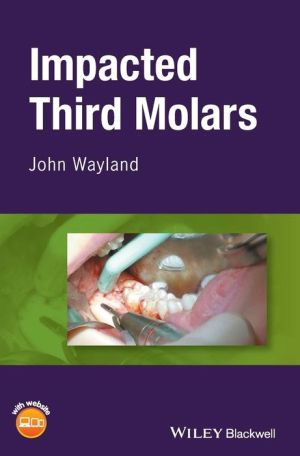 Third Molar Extraction