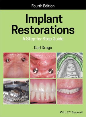 Implant Restorations - A Step-by-Step Guide 4e